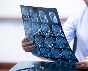 Polipílula contra hipertensão pode reduzir em 39% a recorrência de AVC